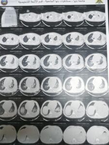 فريق طبي ينجح في استئصال ورم من صدر طفلة بمستشفى بنها الجامعي