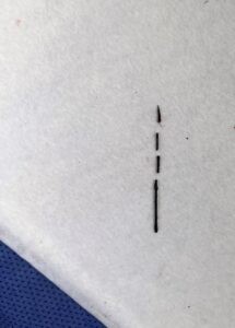 ظلت في ظهره عامين .. استخراج إبرة تنجيد من مريض ببنها الجامعي