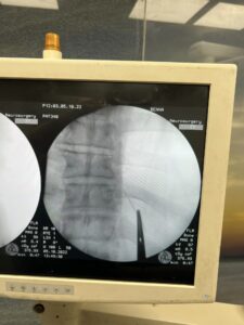 ظلت في ظهره عامين .. استخراج إبرة تنجيد من مريض ببنها الجامعي