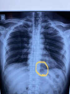 ظلت في ظهره عامين .. استخراج إبرة تنجيد من مريض ببنها الجامعي