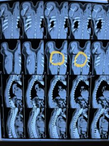 ظلت في ظهره عامين .. استخراج إبرة تنجيد من مريض ببنها الجامعي