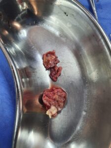 تفاصيل إنقاذ حالتي طفلة وسيدة كانتا تعانيان من مشاكل في صمامات القلب بمستشفى بنها الجامعي