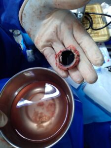 تفاصيل إنقاذ حالتي طفلة وسيدة كانتا تعانيان من مشاكل في صمامات القلب بمستشفى بنها الجامعي