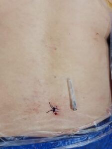 إجراء أول عملية جراحية باستخدام المنظار الجراحي للعمود الفقري بمستشفى جامعة بنها