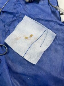 صور - إنقاذ حياة طفل ابتلع حبة "سوداني" بمستشفى بنها الجامعي