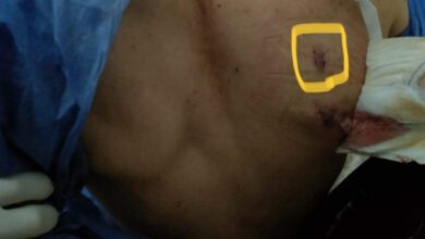 أصيب بطعنة مطواه بالصدر .. إنقاذ حياة شاب بجراحة عاجلة بمستشفى بنها الجامعي أصيب بطعنة مطواه بالصدر .. إنقاذ حياة شاب بجراحة عاجلة بمستشفى بنها الجامعي