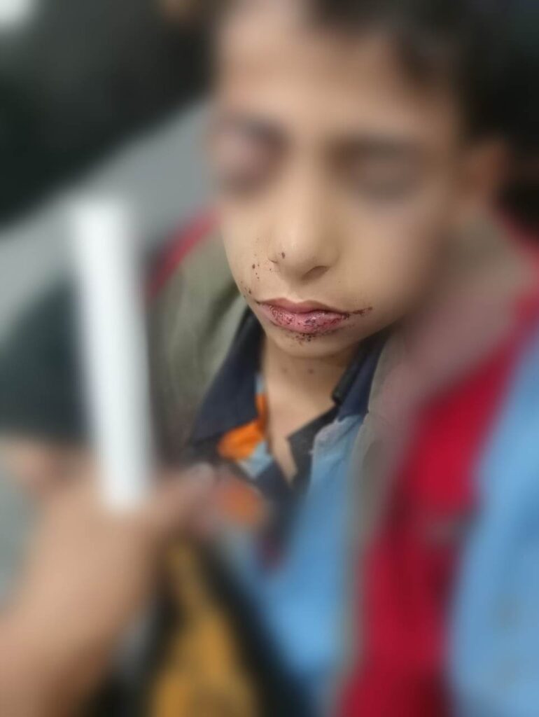 طفل يفقد عينيه بطلق خرطوش أثناء عودته من المدرسة .. ووالده: عايز حق ابني