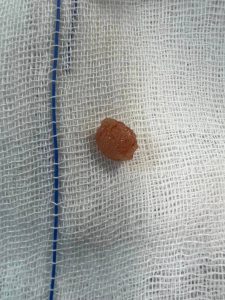 استخراج ورم من الحنجرة .. فريق جراحي يتمكن من إنقاذ طفل بمستشفى بنها الجامعي