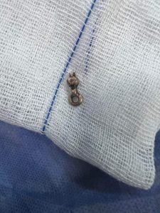 إنقاذ حياة طفلين بعد استخراج بقايا سلسلة ذهبية ولب بمستشفى بنها الجامعي