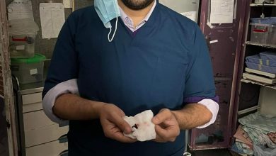 قطعة قلم جاف محشورة في القصبة الهوائية.. إنقاذ طفل بمستشفى بنها الجامعي
