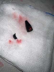 قطعة قلم جاف محشورة في القصبة الهوائية.. إنقاذ طفل بمستشفى بنها الجامعي