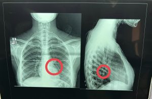 صور - إنقاذ حياة فتاة ابتلعت "دبوس" عن طريق الخطأ ببنها الجامعي