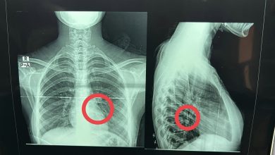 صور - إنقاذ حياة فتاة ابتلعت "دبوس" عن طريق الخطأ ببنها الجامعي