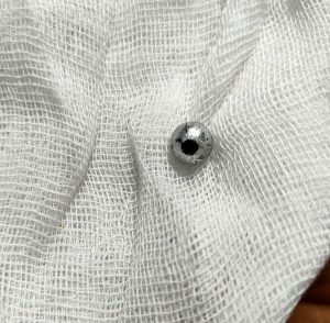 إنقاذ طفلة ابتلعت خرزة شخشيخة أطفال ببنها الجامعي