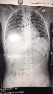 إنقاذ طفلة ابتلعت خرزة شخشيخة أطفال ببنها الجامعي