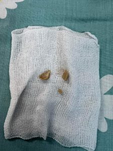 إنقاذ حياة رضيع ابتلع 4 قطع كاملة من السوداني بمستشفى بنها الجامعي - صور 