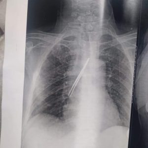 استخراج "ملقاط شعر" من القصبة الهوائية لمريض بمستشفى بنها الجامعي