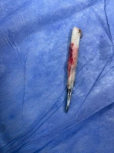 استخراج "ملقاط شعر" من القصبة الهوائية لمريض بمستشفى بنها الجامعي