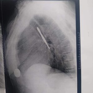 استخراج "ملقاط شعر" من القصبة الهوائية لمريض بمستشفى بنها الجامعي