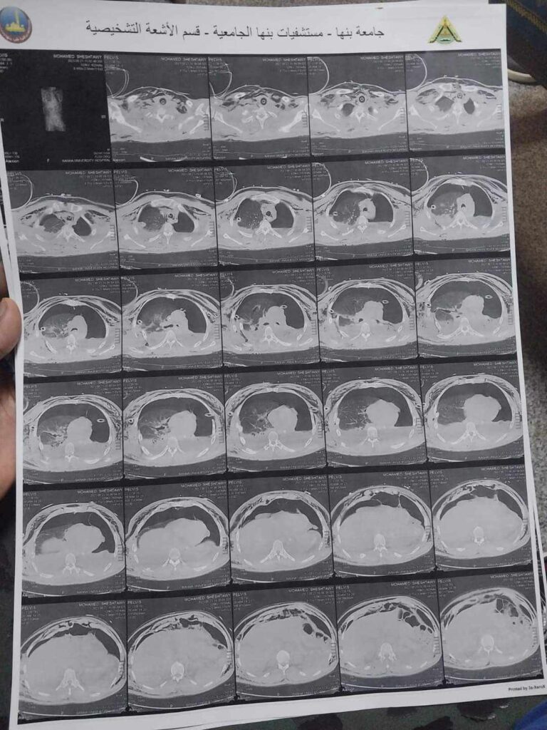 إنقاذ شاب بإجراء جراحة عاجلة لبناء القفص الصدري بمستشفى بنها الجامعي إنقاذ شاب بإجراء جراحة عاجلة لبناء القفص الصدري بمستشفى بنها الجامعي