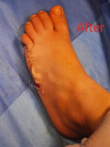 استئصال "إصبع زائد" لطفلة عمرها عامين ونصف بمستشفى الخانكة التخصصي (صور)