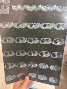 إنقاذ حياة شاب تعرض لطعنة نافذة في مستشفى كفر شكر