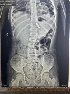 فريق طبي بأطفال بنها التخصصي ينقذ حياة طفلة ابتلعت جزء من "براية"