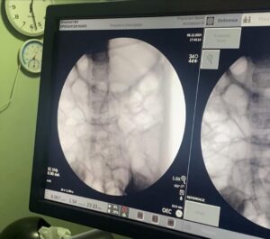 فريق طبي بأطفال بنها التخصصي ينقذ حياة طفلة ابتلعت جزء من "براية"