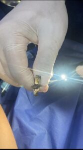 فريق طبي بأطفال بنها التخصصي ينقذ حياة طفلة ابتلعت جزء من "براية"