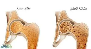 مرض هشاشة العظام .. الأسباب والأعراض والعلاج