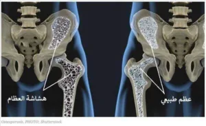 مرض هشاشة العظام .. الأسباب والأعراض والعلاج
