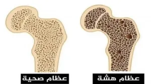مرض هشاشة العظام .. الأسباب والأعراض والعلاج