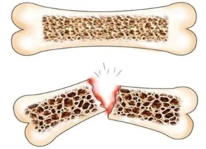 مرض هشاشة العظام .. الأسباب والأعراض والعلاج