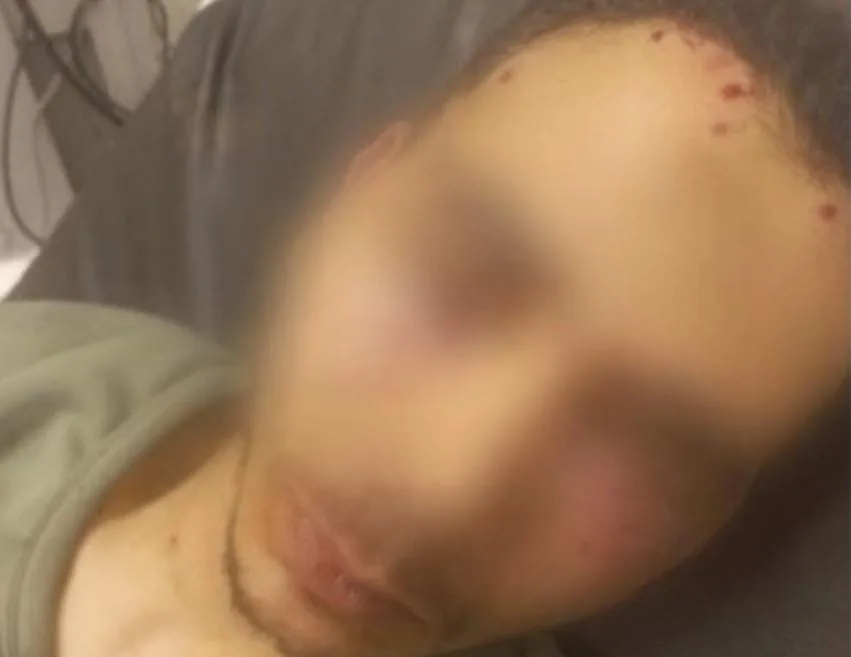 عامل يفقد عينه برصاصة طائشة أثناء مروره بجوار مشاجرة بشبرا الخيمة