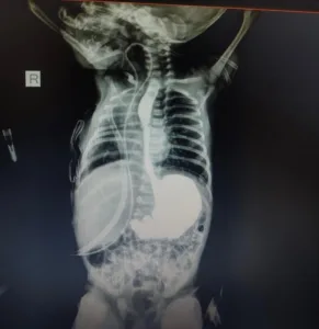 الطعام يختلط بمجرى التنفس .. إنقاذ رضيعة تعاني من عيب خلقي نادر بمستشفى الخانكة التخصصي