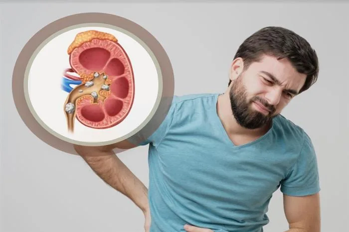 مشروبات تحمي الكلى وأخرى تضرها: دليل للوقاية من حصوات الكلى
