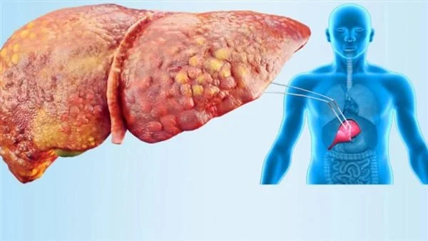 تجنب تلك المأكولات .. أطعمة تسبب مشاكل صحية للكبد