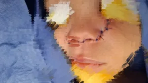 فريق جراحي بمستشفى قها التخصصي ينقذ أنف طفلة من التشوه بعد حادث أليم