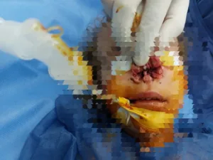 فريق جراحي بمستشفى قها التخصصي ينقذ أنف طفلة من التشوه بعد حادث أليم