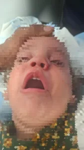 فريق جراحي بمستشفى قها التخصصي ينقذ أنف طفلة من التشوه بعد حادث أليم