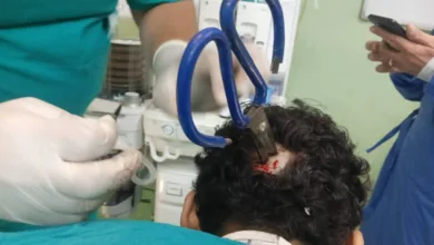 جراحة دقيقة تنقذ مريضًا بمستشفى بنها بعد استخراج مقص مغروز في الجمجمة