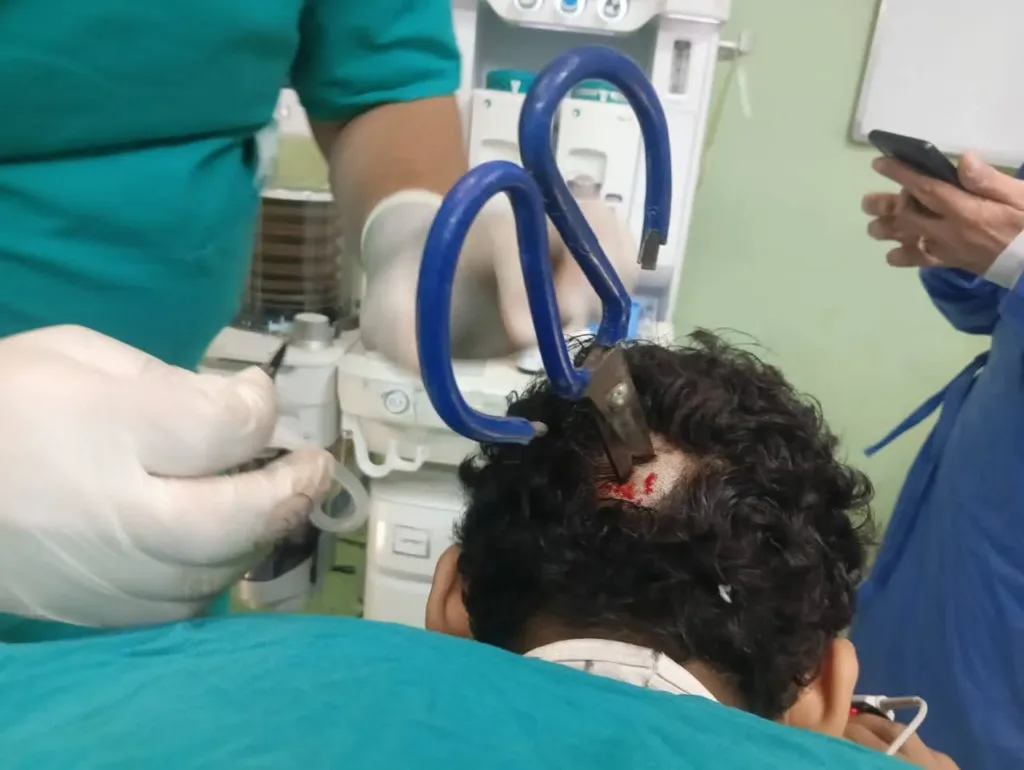 جراحة دقيقة تنقذ مريضًا بمستشفى بنها بعد استخراج مقص مغروز في الجمجمة