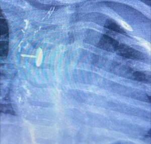 بطولة بيضاء داخل غرفة العمليات ببنها.. إنقاذ طفلة ابتلعت دبوسًا ظل في مريئها 6 أشهر