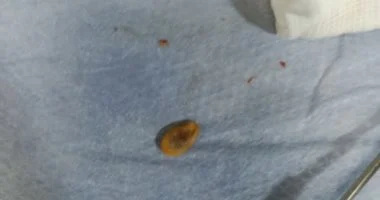 إنقاذ طفل ببنها بعد استخراج حبة لب من الشعب الهوائية استمرت شهرًا وتسببت في التهاب رئوي