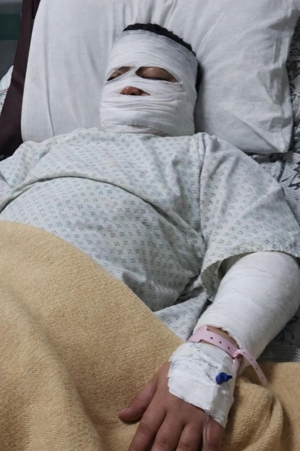 إصابة طفل بحروق بالغة إثر سقوطه على زيت مغلي بعد اصطدامه بدراجة نارية ببنها إصابة طفل بحروق بالغة إثر سقوطه على زيت مغلي بعد اصطدامه بدراجة نارية ببنها