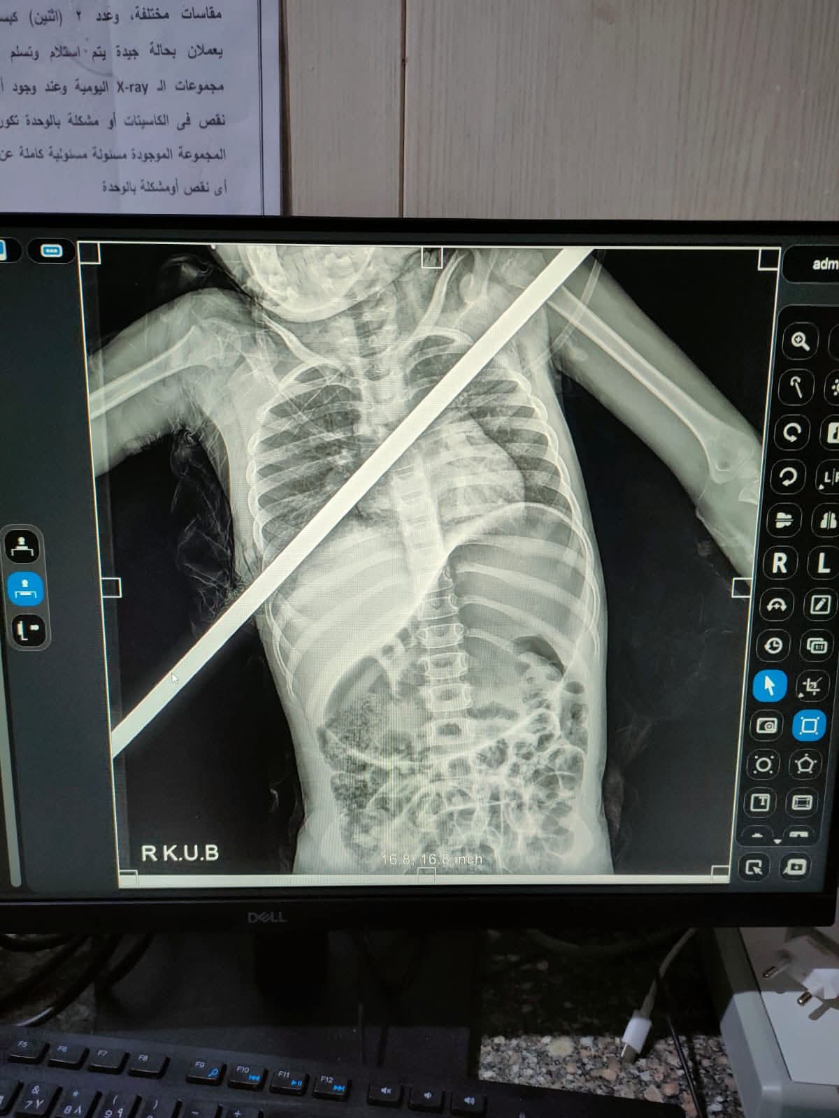 إنقاذ طفلة بعد اختراق سيخ حديدي صدرها بالكامل في عملية جراحية معقدة ببنها الجامعية إنقاذ طفلة بعد اختراق سيخ حديدي صدرها بالكامل في عملية جراحية معقدة ببنها الجامعية