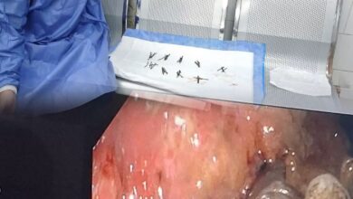 استخراج 100 مسمار وصامولة من معدة مريض بمستشفى جامعة بني سويف