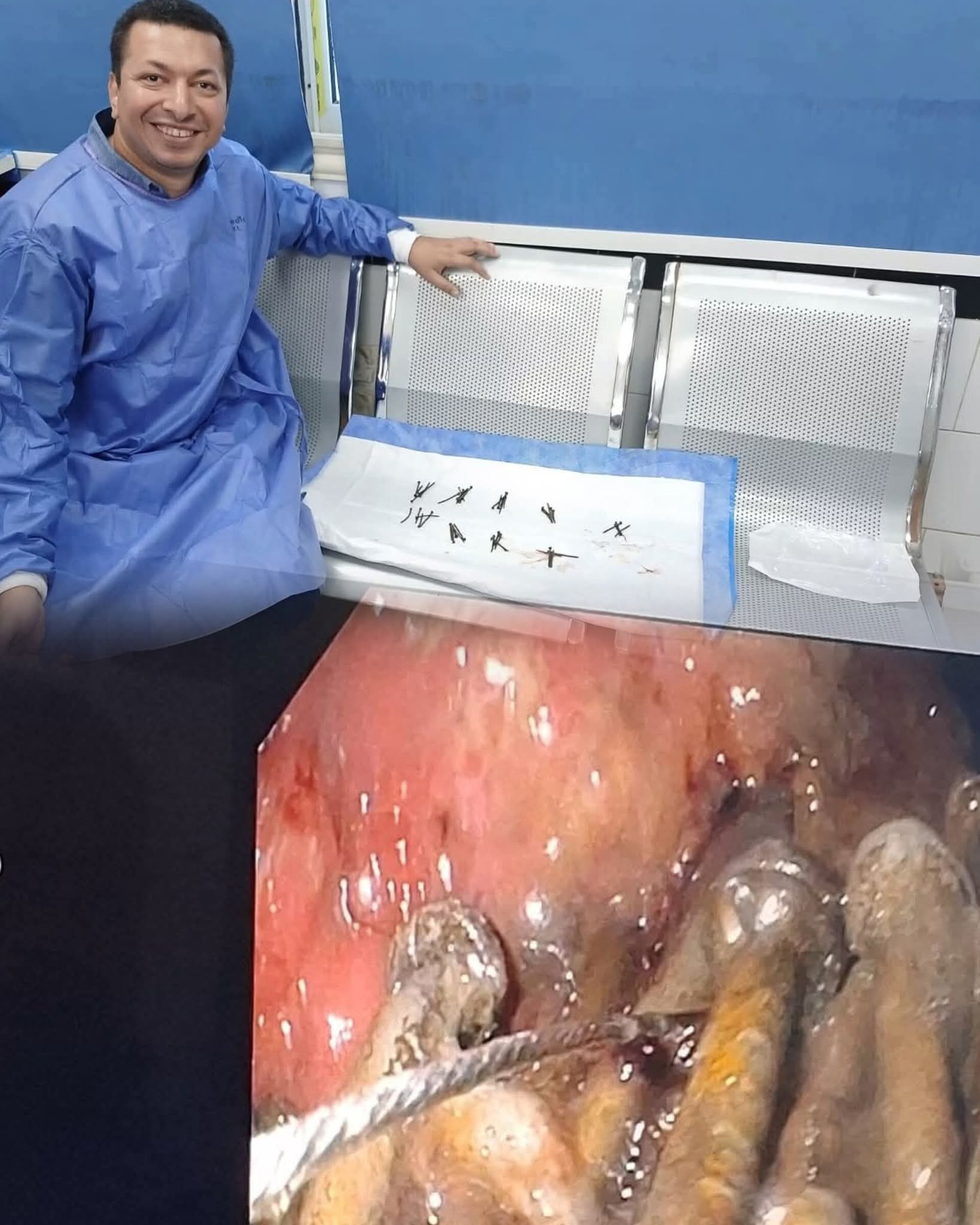 استخراج ١٠٠ مسمار وصامولة من معدة مريض بمستشفى جامعة بني سويف استخراج ١٠٠ مسمار وصامولة من معدة مريض بمستشفى جامعة بني سويف