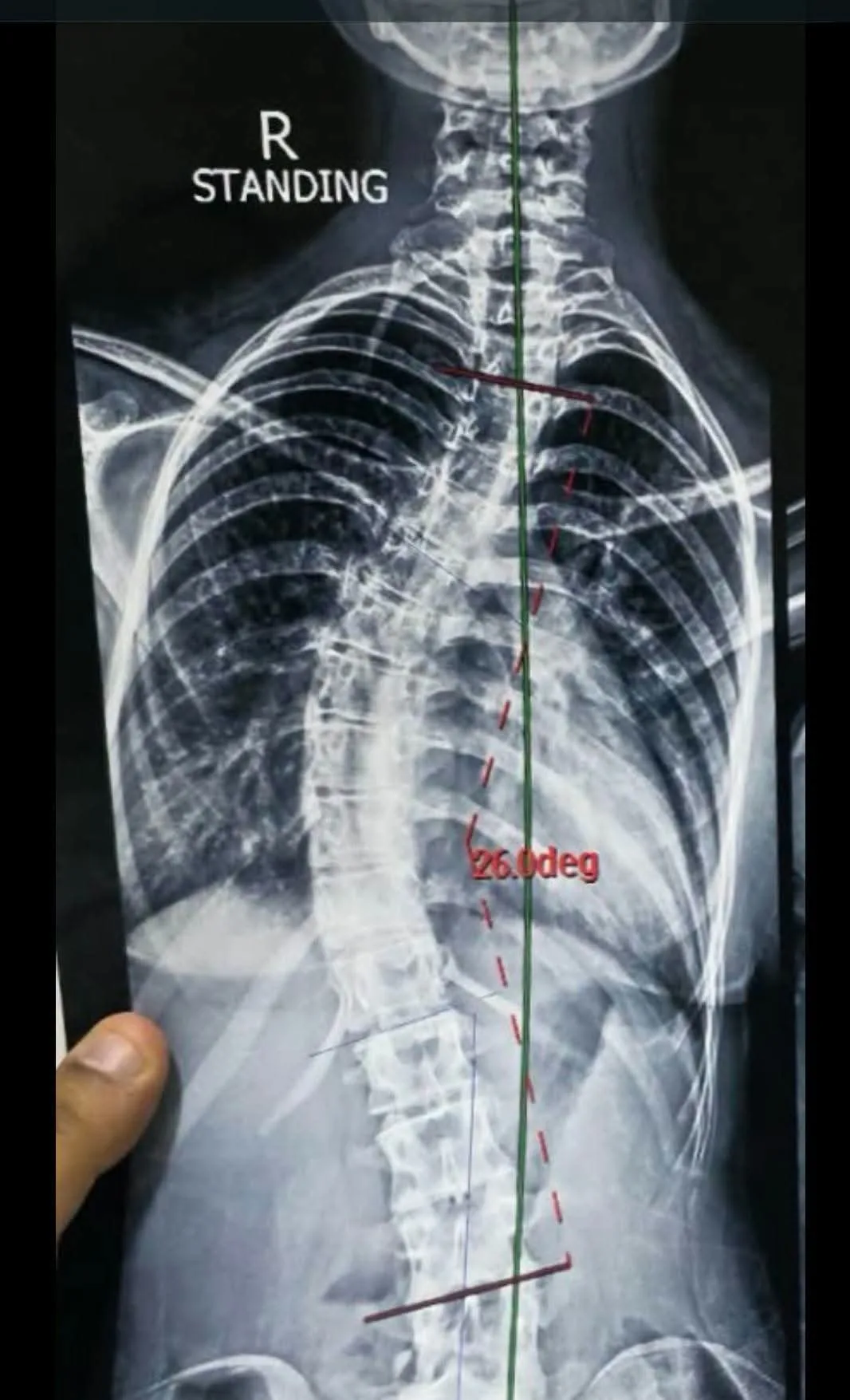 نجاح جراحة دقيقة لطفل عمره 14 عامًا لتصحيح اعوجاج حاد بالعمود الفقري في مستشفيات جامعة بنها